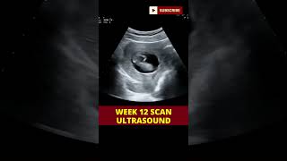 ultrasound scan week 12  pregnancy scan  week by week pregnancy [upl. by Ahseenak770]