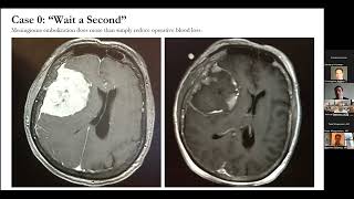 Meningioma Embolization Quantitative Insights and Implications for Minimally Invasive Surgery [upl. by Otreblasiul50]