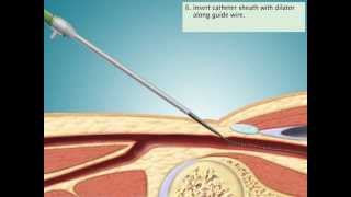 Cardiac Catheterization via Femoral Artery [upl. by Freed393]