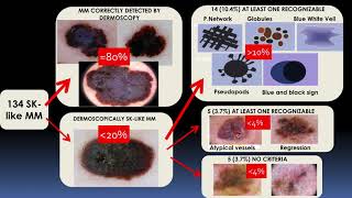 Seborrheic Keratosislike melanomas  Dr Cristina Carrera [upl. by Addy534]