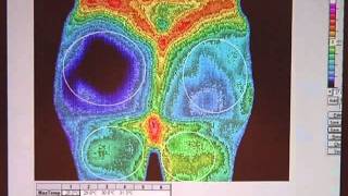 Imaging the Spread of CRPS  Phillip Getson DO Drexel University Philadelphia PA  RSDSA [upl. by Fauman]