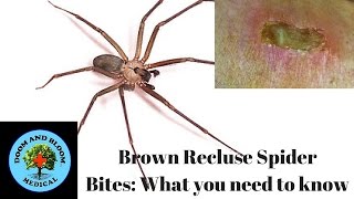 Brown Recluse Spider Bites What you need to know [upl. by Shishko]