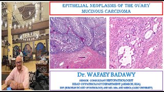 EPITHELIAL NEOPLASMS OF THE OVARY MUCINOUS CARCINOMA BY DR WAFAEY BADAWY [upl. by Ayanahs]