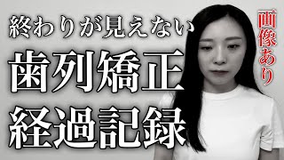 【歯列矯正】あれから2年。終わりが見えない。歯列矯正経過記録画像あり アンフィットamp骨隆起amp圧下 [upl. by Auqenehs]