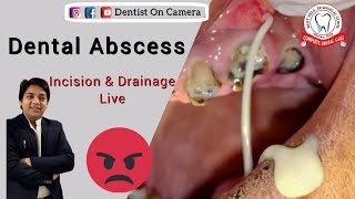 Huge Dentals abscess incision amp drainage [upl. by Florencia]