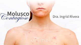 Molusco contagioso [upl. by Atibat46]