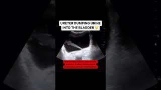 Ureter jetting urine into the bladder [upl. by Etnovahs]