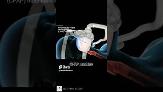 sleep Apnea treatment CPAP machine  HindiUrdu short [upl. by Cathrin]