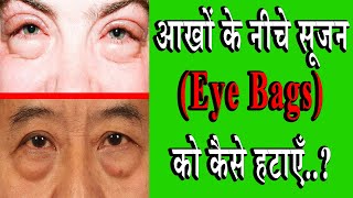 आखों के नीचे सूजन को कैसे हटाएँ How To Eye Remove Bags Naturally [upl. by Pironi840]