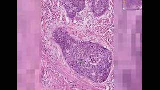 Histopathology Cervix Squamous cell carcinoma [upl. by Sigismondo]