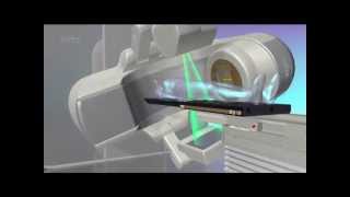 Spine Tumor Treatment  Truebeam STx  Phoenix CyberKnife [upl. by Eckblad]