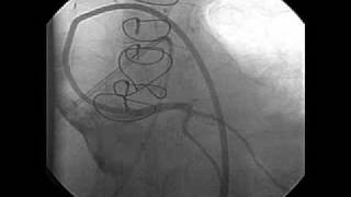 Left Ventricular Dysfunction after Heart Transplantation [upl. by Benil]