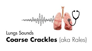 Coarse Crackles Rales  Lung Sounds  Medzcool [upl. by Glassco419]