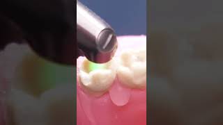 Retiro de caries con láser Sin fresa 🥺 Odontología Láser shorts [upl. by Assile]