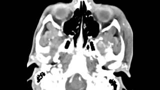 Mandibular Condyle Osteochondroma [upl. by Charo]