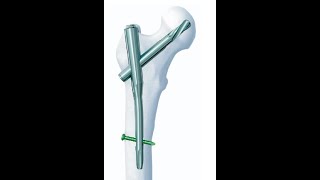 Proksimal femur çivisi  Proximal femoral nail [upl. by Ahsad]