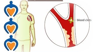 Thrombosis  What is it and how is it treated [upl. by Anitsirhcairam]