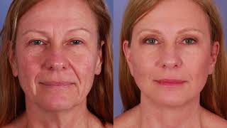 Facelift vs Mini Facelift  Stoker Plastic Surgery [upl. by Gelya]