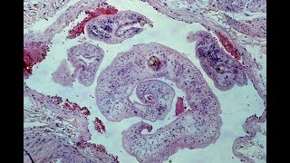 Schistosomiasis  Pathology mini tutorial [upl. by Infeld]