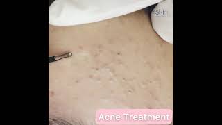 Comedone Extraction Acne Treatment [upl. by Atirrehs]