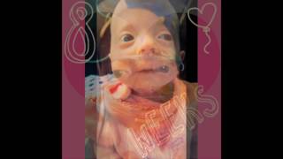 Katierae Trisomy 18 Awareness [upl. by Eeroc183]