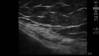 Ultrasound guided pes anserine bursitis injection [upl. by Lamonica]