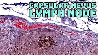 Benign Nevus in a Sentinel Lymph Node Capsular nevus with Ki67MART1 immunostain pathology [upl. by Mckeon]