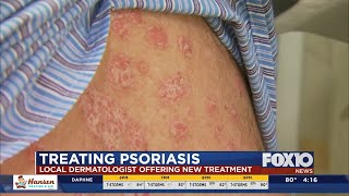 New treatment for psoriasis [upl. by Linnette]