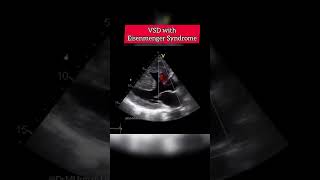 VSD with Eisenmenger Syndrome echocardiography echocardiogram echo shorts [upl. by Yer]