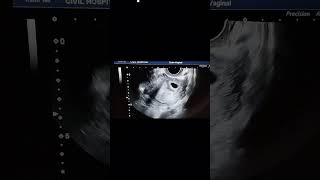 Uterine Scar ectopic pregnancy [upl. by Maren]