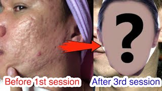 CO2 Fractional Laser 3rd Session result after 7 days Acne Scar treatment [upl. by Ielak]