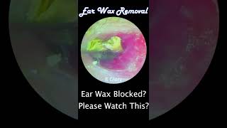 1020  Your Ear Wax Blocked earwaxremoval [upl. by Aratehs814]