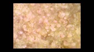 Scabies mites on skin crust [upl. by Michaela]