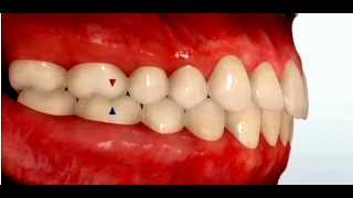 Class II Malocclusion [upl. by Finnegan]