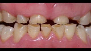 Surgical Crown Lengthening on Severe Tooth Surface Loss [upl. by Atiz]