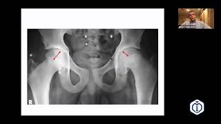 Slipped Capital Femoral Epiphysis SCFE Prof Hisham Abdel Ghani LRS PD Academy B2B [upl. by Brenza256]