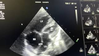 Corrected Transposition of Great arteries  L TGA [upl. by Acemahs]