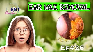 Doctor Reveals BEST Earwax Removal Technique [upl. by Easter103]