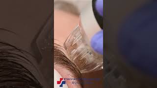 RadioFrequency Microneedling in Slow Motion [upl. by Eudoca977]