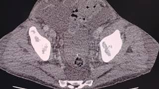 Hemoperitoneum and hemoretroperitoneum in polycystic disease with hemorrhagic renal cysts [upl. by Brenna755]