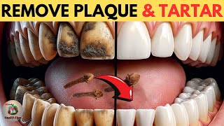 Remove Plaque amp Tartar Buildup with these 6 Natural Ways [upl. by Aik302]