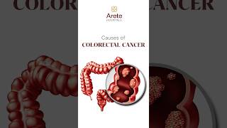 Understanding Colon Cancer Risk Factors and Causes  Dr Sharvani Duba Arete Hospitals coloncancer [upl. by Ryhpez252]