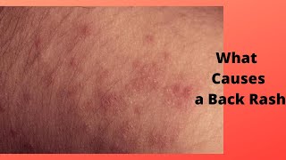 What Causes a Back Rash [upl. by Weissman90]