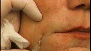 How to Lift Mouth Corners amp Marionettes With A Dermal Filler [upl. by Cannon]