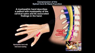 Compression of the Spinal Cord amp Hand Function  Everything You Need To Know  Dr Nabil Ebraheim [upl. by Lust336]