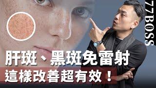 肝斑、黑斑如何去除？內調加外用，改善效果一級棒！【77老大】 [upl. by Grayce926]