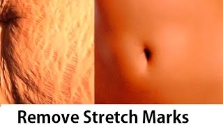 How to Get Rid of Stretch Marks  Naturally amp Fast  Home DIY  Superwowstyle Prachi [upl. by Schweiker753]