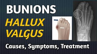 Bunions Hallux Valgus Symptoms Causes XRay amp Treatment [upl. by Ueihtam223]