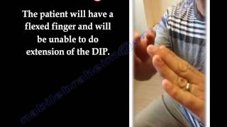 Mallet Finger  Everything You Need To Know  Dr Nabil Ebraheim [upl. by Ballman]