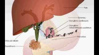 Obstruction des voies biliaires [upl. by Abbate]